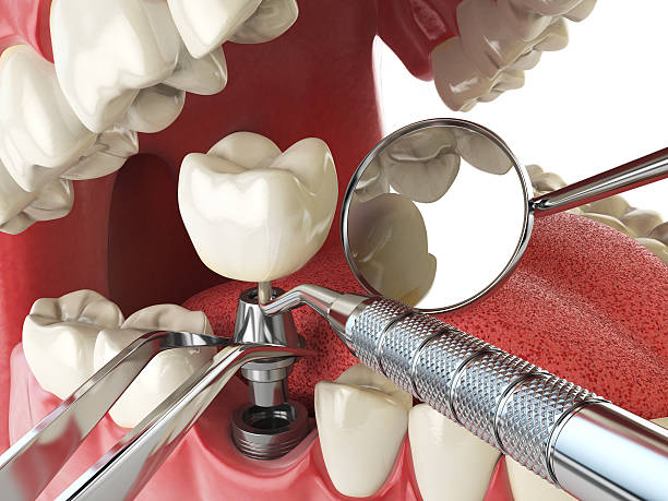 Best Emergency Broken Tooth Repair in Holloman Af, NM